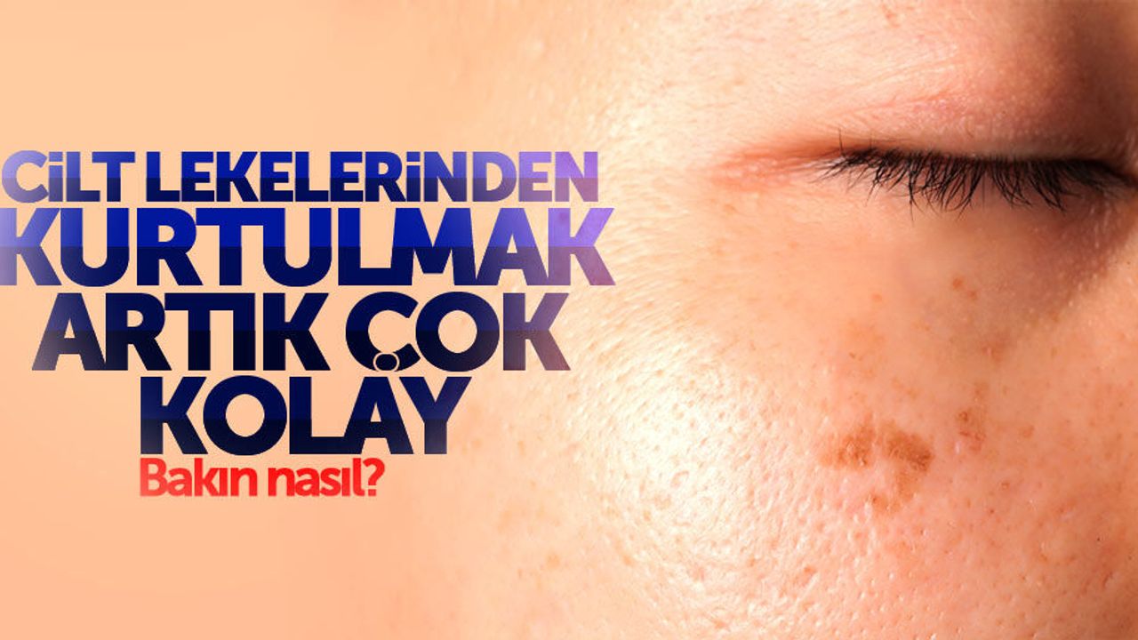 Cilt lekelerinden nasıl kurtulunur? İşte Cevabı!