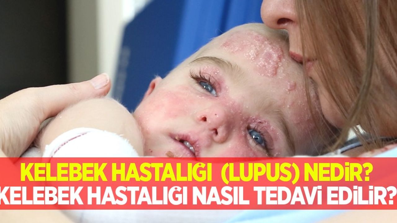 Kelebek hastalığı (lupus) nedir, belirtileri nelerdir? Kelebek hastalığı nasıl tedavi edilir?