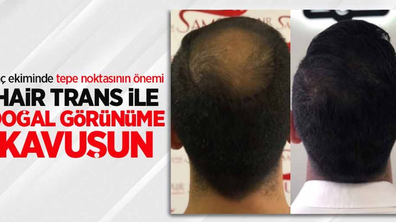 Saç ekiminde tepe noktasının önemi: Hair Trans ile doğal görünüme kavuşun