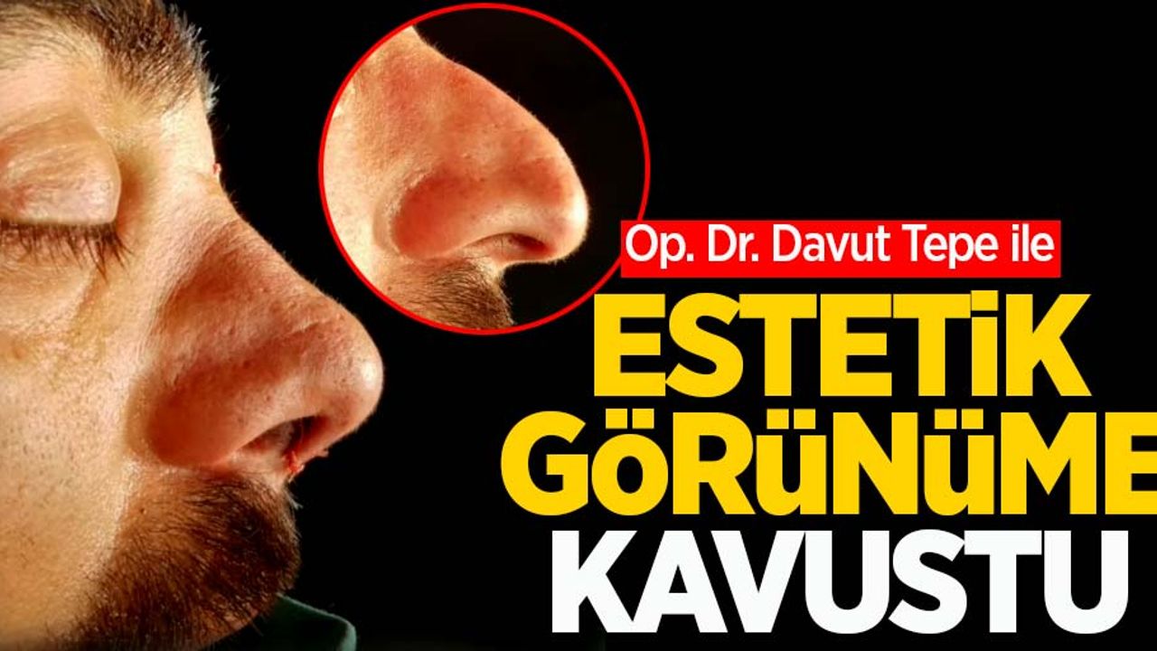 Op. Dr. Davut Tepe ile estetik görünüme kavuştu