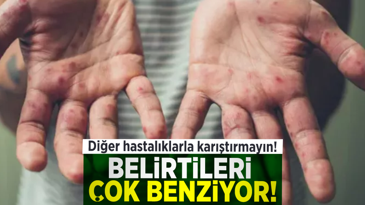 Başka Hastalıklar Karıştırmayın! Belirtileri Çok Benziyor!