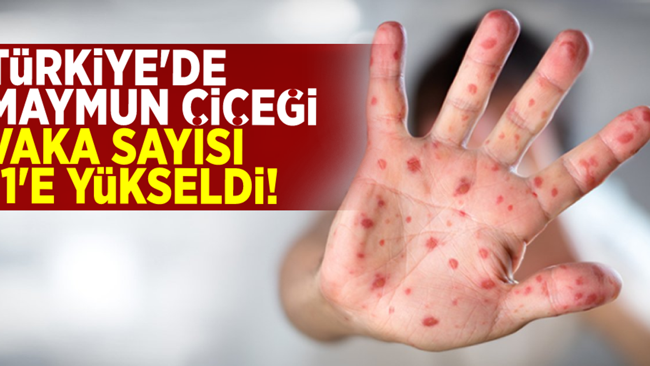 Türkiye'de Maymun Çiçeği Vaka Sayısı 11' e Yükseldi!