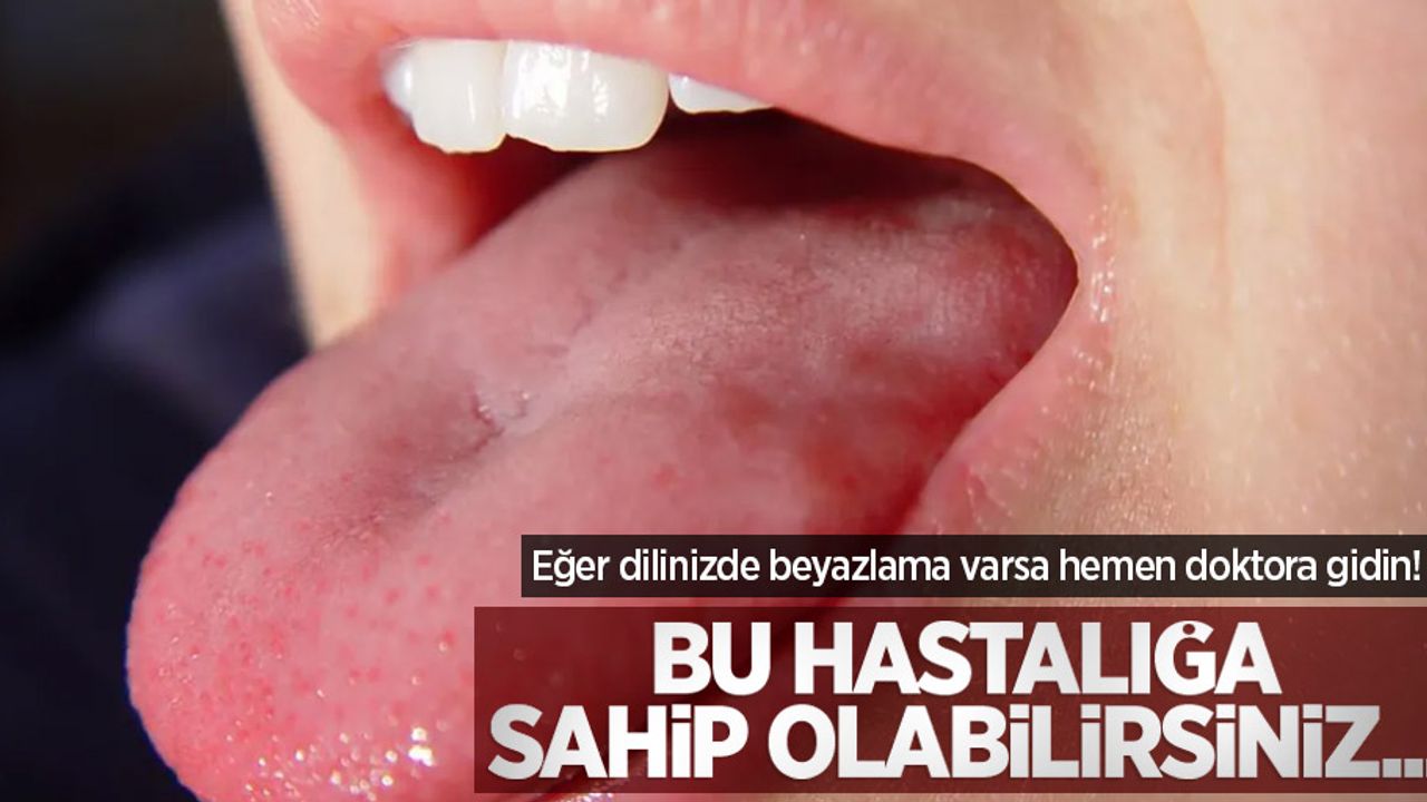 Eğer dilinizde beyazlama varsa hemen doktora gidin! Bu hastalığa sahip olabilirsiniz...