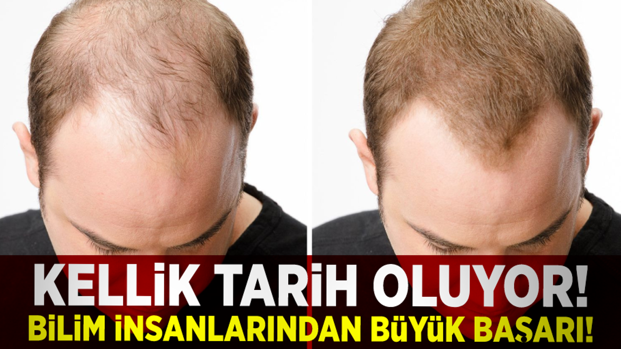 Bilim İnsanları Bunu da Başardı! Kellik Tarih Oluyor!