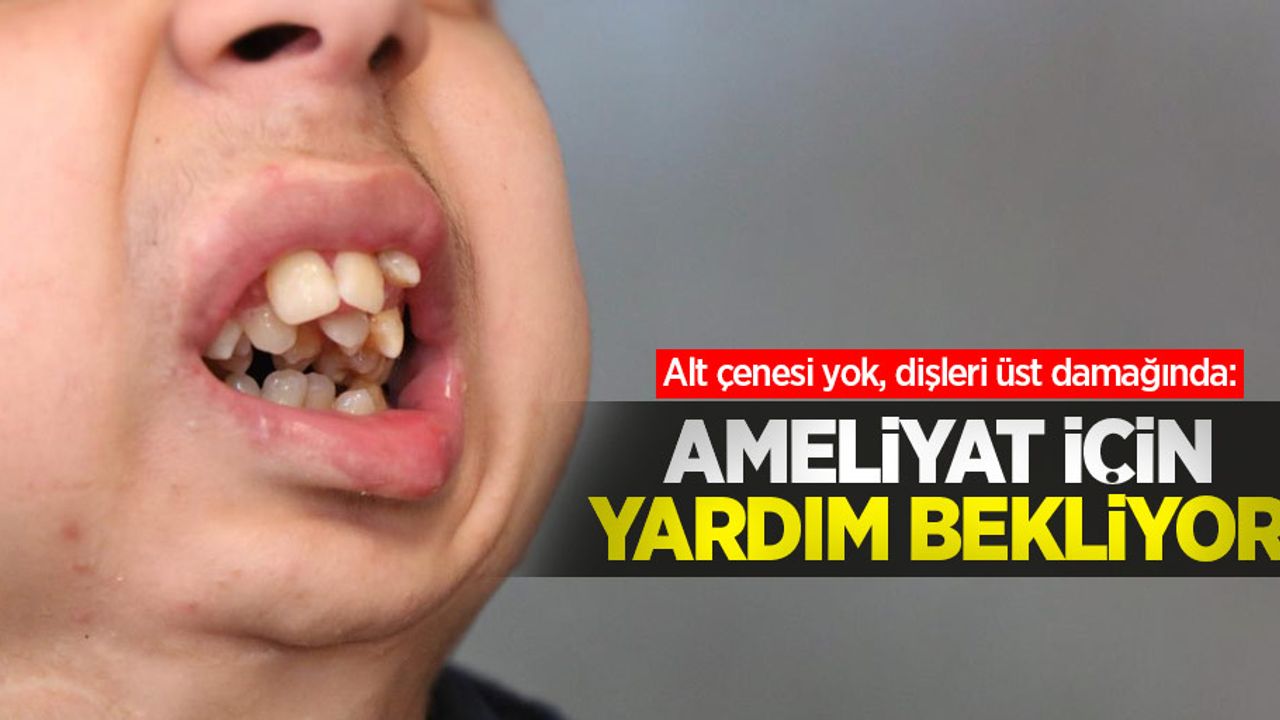 Alt çenesi yok, dişleri üst damağında: Ameliyat için yardım bekliyor