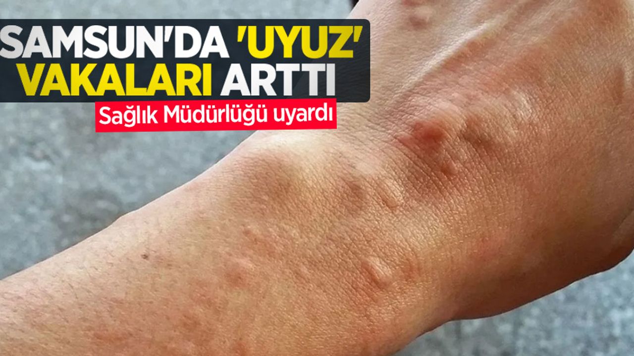 Samsun'da ‘uyuz’ vakaları arttı, Sağlık Müdürlüğü uyardı