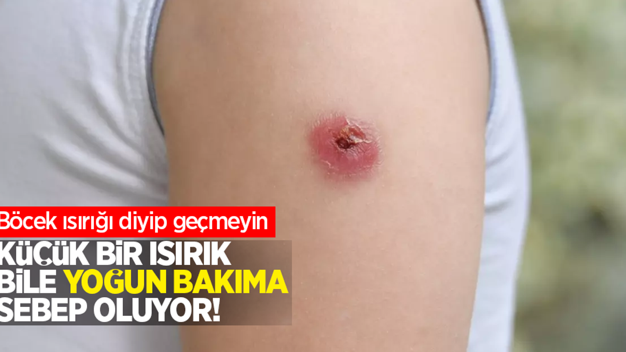 Böcek ısırığı deyip geçmeyin: Küçük bir ısırık bile yoğun bakıma sebep oluyor!