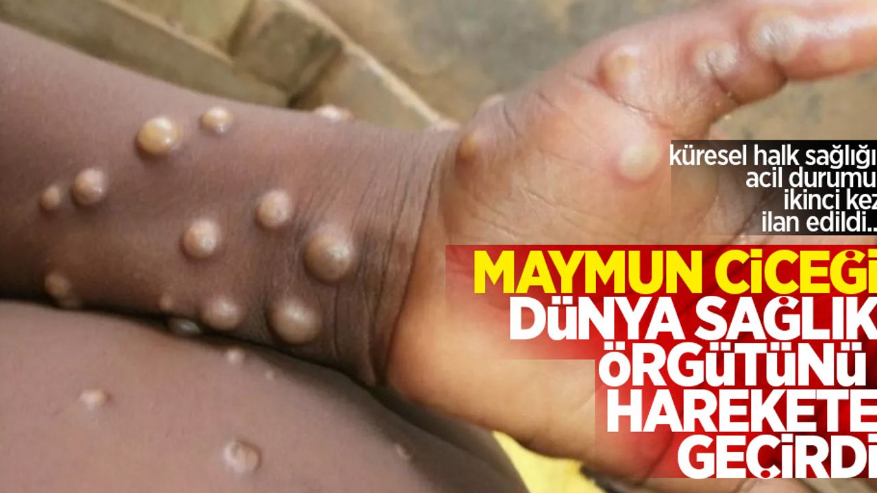 Maymun çiçeği Dünya Sağlık Örgütü'nü harekete geçirdi: Küresel halk sağlığı acil durumu ikinci kez ilan edildi...