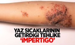 Yaz sıcaklarının getirdiği tehlike ‘impertigo’