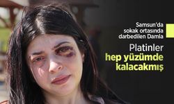Samsun'da sokak ortasında darbedilen Damla: Platinler hep yüzümde kalacakmış