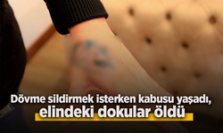 Dövme sildirmek isterken kabusu yaşadı, elindeki dokular öldü
