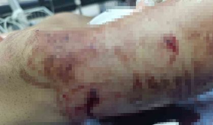 ayının saldırdığı çocuk yaralandı