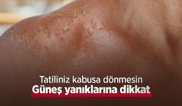 Tatiliniz kabusa dönmesin: Güneş yanıklarına dikkat