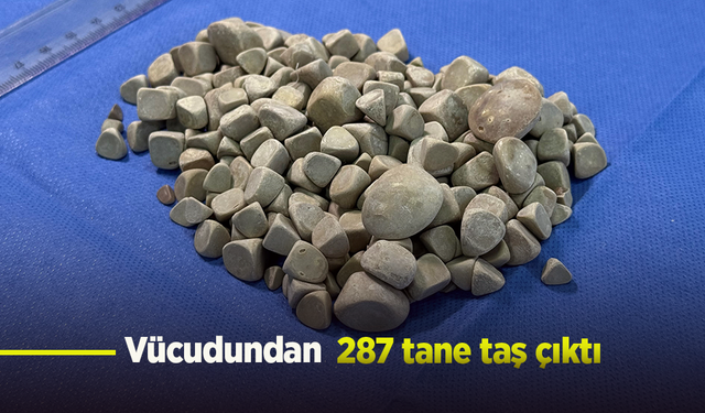 Vücudundan 287 tane taş çıktı.