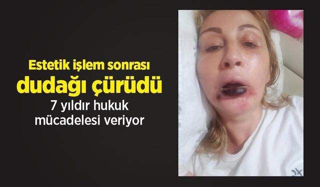 Estetik işlem sonrası dudağı çürüdü, 7 yıldır hukuk mücadelesi veriyor