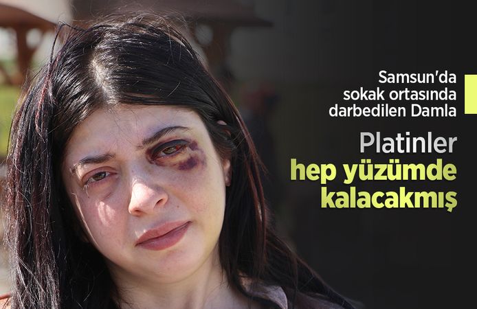 Samsun'da sokak ortasında darbedilen Damla: Platinler hep yüzümde kalacakmış