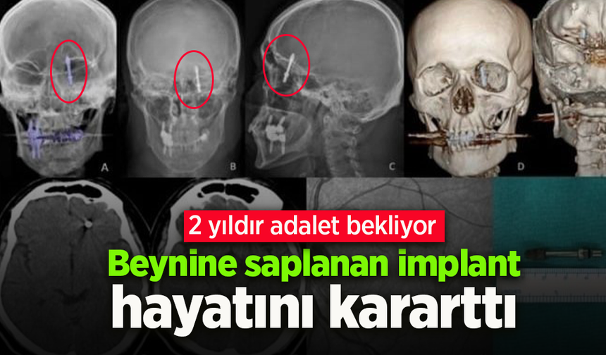 Beynine saplanan implant hayatını kararttı: 2 yıldır adalet bekliyor.