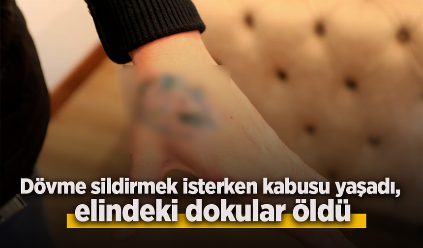 Dövme sildirmek isterken kabusu yaşadı, elindeki dokular öldü