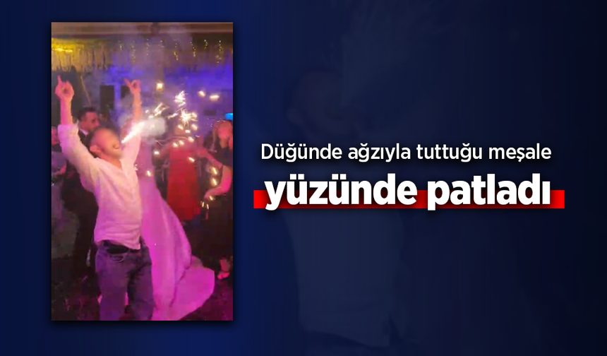 Düğünde ağzıyla tuttuğu meşale yüzünde patladı