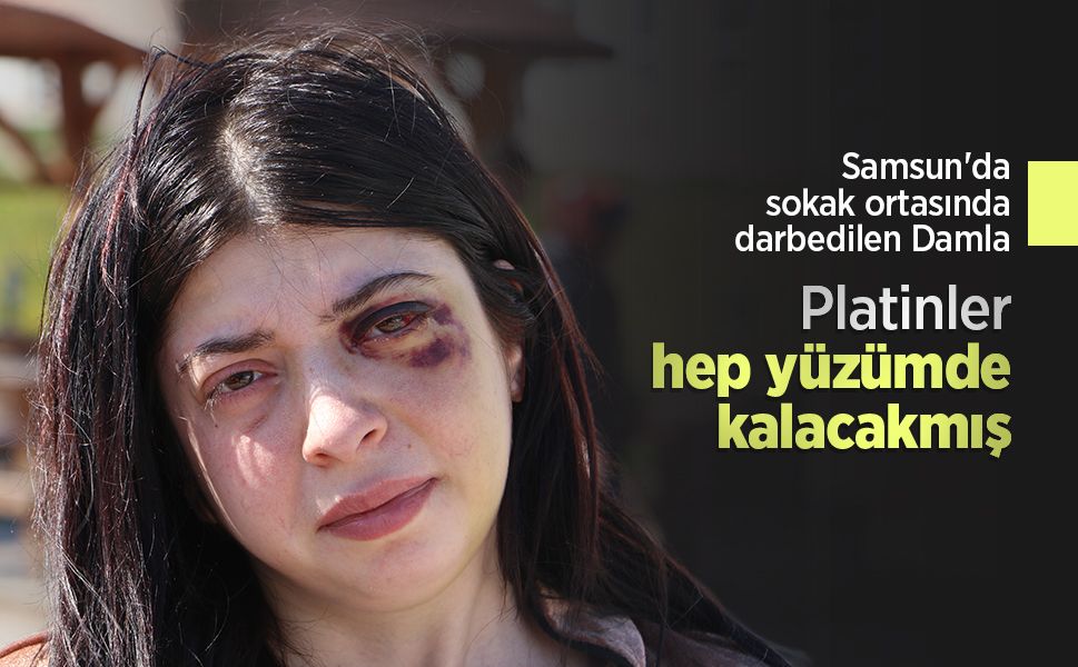 Samsun'da sokak ortasında darbedilen Damla: Platinler hep yüzümde kalacakmış