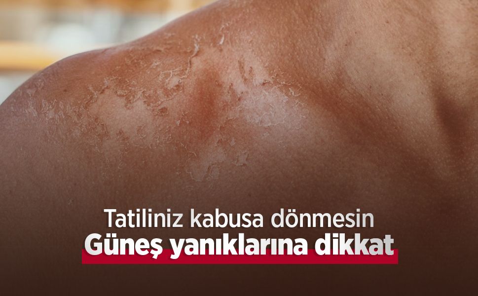 Tatiliniz kabusa dönmesin: Güneş yanıklarına dikkat