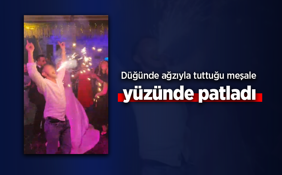Düğünde ağzıyla tuttuğu meşale yüzünde patladı