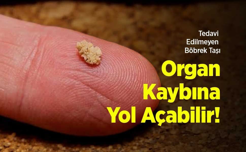 Tedavi Edilmeyen Böbrek Taşı Organ Kaybına Yol Açabilir!