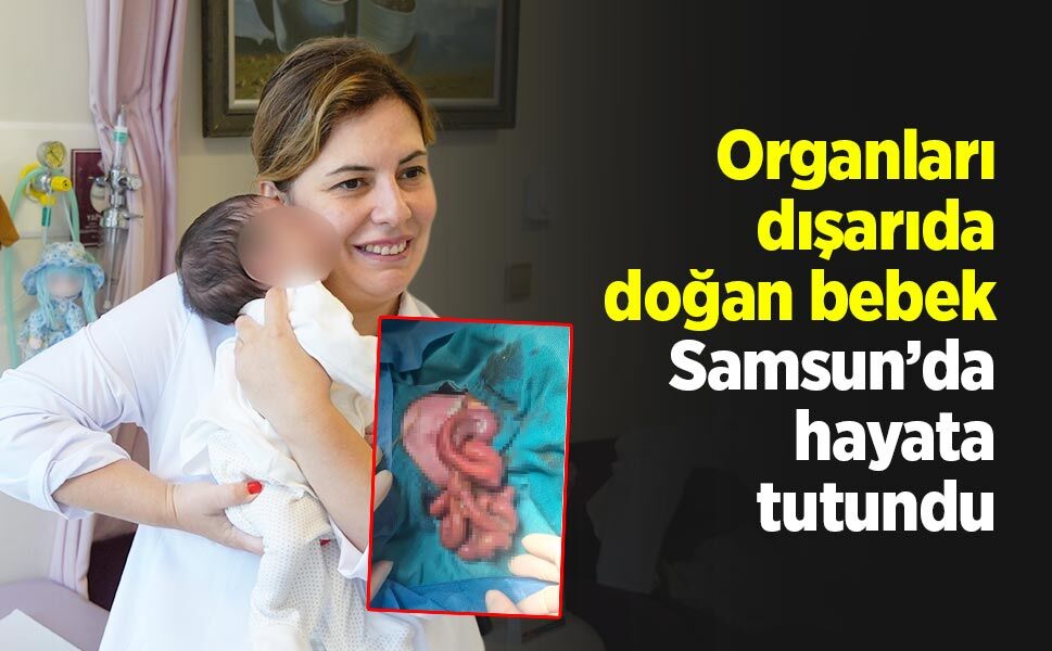 Organları dışarıda doğan bebek, Samsun’da hayata tutundu